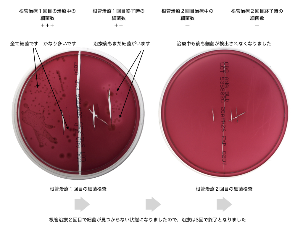 根管治療の際の細菌検査
